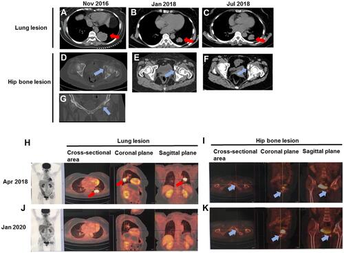 Figure 1 PET-CT/CT scans of the primary lung tumor and hip bone lesion. Chest CT scans of the primary lung tumor prior to first-line treatment (A), after first-line treatment (B), and after second-line treatment (C); Pelvis CT scans of the hip bone lesion prior to first-line treatment (D and G), after first-line treatment (E), and after second-line treatment (F); PET-CT scans of the primary lung tumor in Apr 2018 (H) and Jan 2020 (J); PET-CT scans of the metastatic lesion to left hip joint in Apr 2018 (I) and Jan 2020 (K). Red arrows indicated the primary lung tumors and blue arrows indicated the hip bone lesions.