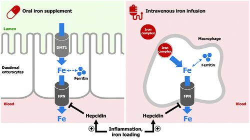 Figure 1. The mechanism of oral and intravenous iron treatments. Iron administered via an oral iron supplement is absorbed by duodenal enterocytes. Divalent metal transporter 1 (DMT1) imports iron across the apical surface of enterocytes, whereas ferroportin exports iron across the basolateral surface. The hormone hepcidin, which is increased by iron loading or inflammation, impairs cellular iron export into blood by causing ferroportin degradation. Intravenous iron preparations are administered by infusion, and the iron‒carbohydrate complex is taken up and processed by macrophages in the liver, spleen and marrow. Once iron is released into the cytoplasm, it is either stored in ferritin or exported from macrophages through ferroportin (FPN). Intravenous iron can overcome the hepcidin-mediated block of iron absorption from the gut.