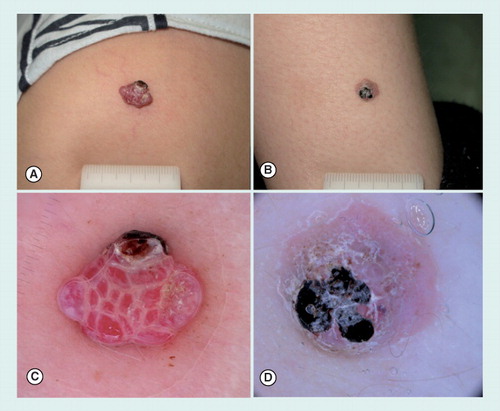 Figure 7. Clinical images of a pyogenic granuloma and an atypical Spitz tumor.(A) A pyogenic granuloma and (B) an atypical Spitz tumor arising on the lower arm of two prepubertal children. Both lesions presented as pink to red nodules, partially covered by a blood crust. (C) Dermoscopy of pyogenic granuloma, displaying multiple red lacunes intersected by whitish lines. In the upper part of the lesion, a small ulcerated area is visible. (D) Aspecific dermoscopic pattern of an atypical Spitz tumor presenting a pink background with a few dotted vessels and a keratotic surface partially covered by a blood crust.