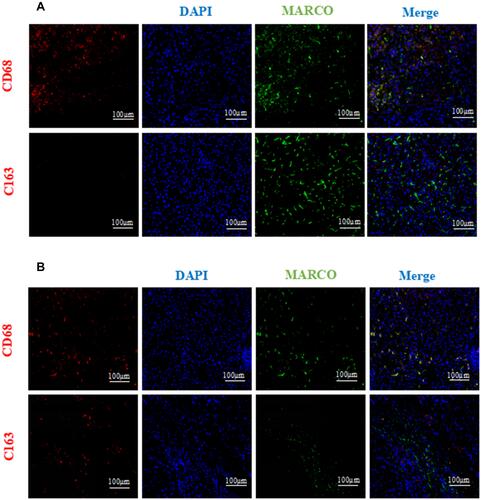 Figure 4 Immunofluorescence analysis of MARCO, CD63 and CD163 expression in paired HCC (A) and matched nontumor tissues (B).