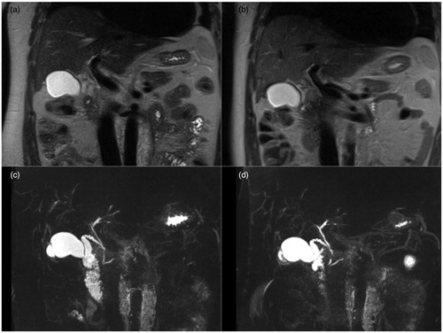 Figure 2. Coronal T2-weighted HASTE and 3 D MRCP (MIP) of a 38-year-old patient with PSC. Time-point 1 (b) and (d) and time point 2 (a) and (c). Reader A interpreted the radiological course of duct changes between the two time points as subtle regression whereas reader B as subtle progression.