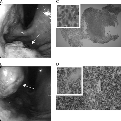 Figure 1.  Endoscopic examination found two polypoid tumors with surface nodularity and ulceration at the (A) mid-body and (B) upper-body. (C) Microscopic features and (D) immunohistochemical staining revealed a low-grade B-cell MALToma.