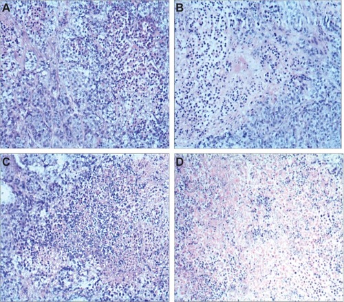 Figure 10 H&E staining images of tumor tissues of tumor-bearing mice.Notes: Tumor-bearing mice were treated with naked siRNA (A), blank TPGS-b-(PCL-ran-PGA) nanoparticles (B), scrambled siRNA-loaded TPGS-b-(PCL-ran-PGA) nanoparticles (C), and siRNA targeting HIF-1α-loaded TPGS-b-(PCL-ran-PGA) nanoparticles (D). The scale bar for images (A–D) is magnification ×100 by microscopy.Abbreviations: HIF-1α, hypoxia-inducible factor-1α; H&E, hematoxylin and eosin; NP, nanoparticle; TPGS-b-(PCL-ran-PGA), D-α-tocopheryl polyethylene glycol 1000 succinate-b-poly(ε-caprolactone-ran-glycolide); siRNA, small interfering ribonucleic acid.