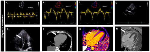 Figure 2. The echocardiogram showed apparently normal left ventricular (LV) systolic and diastolic function (Panel A) with mitral medial e’ velocity (Panel B) higher than the lateral one (Panel C), the so called annulus reversus. IVC was markedly dilated without any variation with inspiration (Panel D). During inspiration the interventricular septum showed a left-sided shift (white arrow on Panel E). A thoracic computed tomography was performed and showed increased pericardial thickness without calcifications (white arrow on Panel F); and a cardiac magnetic resonance showed normal myocardial T1 mapping (Panel G) and diffused pericardial late gadolinium enhancement (white arrow on Panel H) (From reference [Citation26].