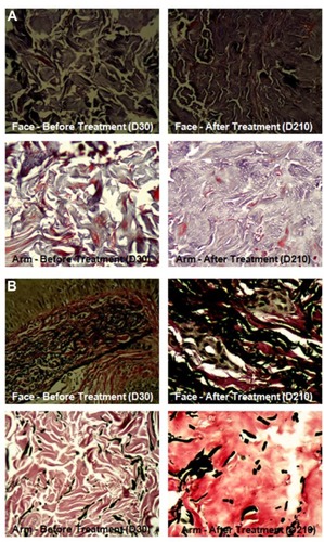 Figure 1 Histological images showing collagen and elastic fibers of face and left arm before and after treatment.