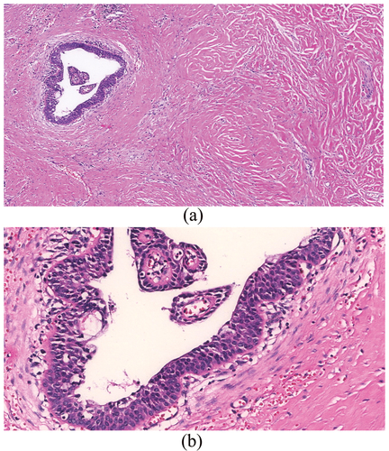 Figure 1. (a) Histological micrograph for SMEC with low neoplastic cellularity and extensive hyalinosclerosis (H&E, ×4); (b) high power imaging of the diagnostic areas showing mucoepidermoid carcinoma islands (H&E, ×40).