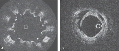 Figure 2. A. OCT image of the distal stent deployed in mid LAD after successful percutaneous thrombectomy, showing a separation of stent struts from the arterial wall, due to stent malapposition. B. OCT image of the distal LAD after successful percutaneous thrombectomy, showing residual stratified thrombus and dissection of the vascular wall.