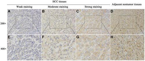 Figure 2 IHC analysis of MARCO expression in paired HCC and matched nontumor tissues.