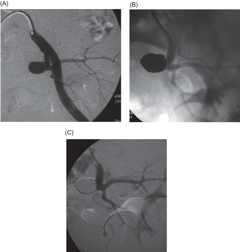 Figure 3. Digital subtraction angiography shows the wide-neck pseudoaneurysm (A). Unsubtracted (B) and subtracted (C) images show the balloon at the neck of the pseudoaneurysm, the coils, and the totally embolized aneurysm.