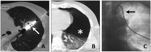 Figure 2. A. 67-y.o. patient with a single metastasis from rectal cancer, 28 mm in diameter, (black asterisk) treated with MWA (white arrow). B. A post treatment pneumothorax was found (white asterisk). C. It required thoracic drain insertion (black arrow). The drain was withdrawn at day 1 and the patient dismissed.