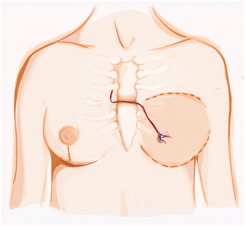 Figure 2. Left DIEP vessels anastomosed to the contralateral IM vessels. The pedicle is passed through an anterior sternal bony groove and the anastomosis were made possible by the symmestrization incision.