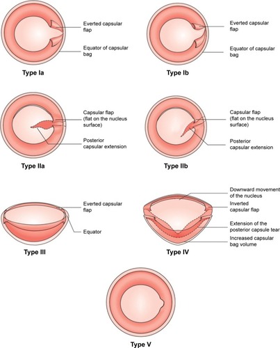 Figure 2 Types of capsular tears.