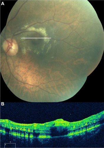 Figure 61 (A) Fundus color photograph shows retinal arterial macroaneurysm and surrounding lipid deposits 1 month after presentation. (B) Cirrus™ optical coherence tomography image shows the retinal arterial macroaneurysm located in the superficial layers and accompanied by multiple lipid deposits, predominantly seen in the outer plexiform layer.