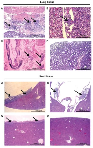 Figure 6 Histopathological evaluation of excised lung tissue (top) and liver tissue (bottom) indicating the presence of cancer cells in mice treated with (A) saline, (B) free carboplatin, and (C) carboplatin-loaded nontargeted liposome. Mice treated with carboplatin-loaded folate receptor-targeted liposome (D) that survived the study period did not show any presence of cancer cells.Notes: Representative images are shown from at least three animals, with arrows indicating the presence of cancer cells.