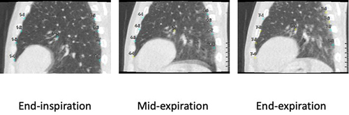 Figure 6 Example images on the median sagittal plane for the left lower lung field for three intermittent time frames in a non-COPD smoker. Median sagittal images for the lower lung field at three intermittent time frames in a 73-year-old male non-COPD smoker demonstrate much smaller movement in the non-dependent pleural aspect compared with the dependent pleural aspect. The MPMVND/D in this case had a negative value of −0.336. Colors of some measurement points on the pleural aspect or lung field center at end-inspiration changed from blue to yellow at mid-inspiration and end-expiration, which means that these yellow points were located outside the displayed median sagittal plane owing to regional lateral movement.