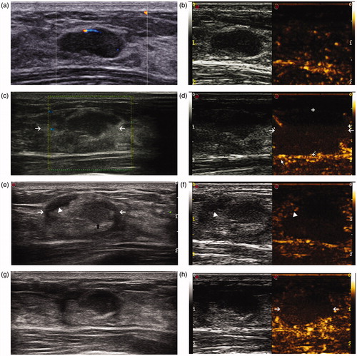 Figure 2. Conventional US and CEUS images in a 28-year-old woman before ablation and during follow-up. (a) US shows a clear tumour before MWA. (b) CEUS shows enhancement before MWA. (c) The ablation zone (arrow) seems to be discernible but not very clear in conventional US 1 week after ablation. (d) No enhancement was observed in the ablation zone (arrow) in CEUS 1 week after ablation. (e) In conventional US 2 months after MWA, the margin (white arrow) of the ablated zone is clear. Moreover, three typical zones are observed, including the hypoechoic tumour (black arrow), the surrounding hyperechogenicity and hypoechogenicity (arrow-head) at the margin of the ablation zone. (f) In CEUS 2 months after MWA, enhancement is observed at the margin of the hypoechogenicity (arrow-head) in US. (g) 6 months after ablation, characteristics are similar to those 2 months after MWA; however, the margin of the ablation zone seems to be vague. (h) The area (arrow) without enhancement is smaller than before about 6 months after MWA in CEUS.