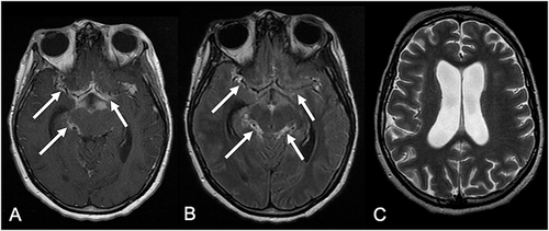 Figure 8 A 44-year-old presented with reduced level of consciousness. Brain MRI demonstrated leptomeningeal enhancement in the basal cisterns, on post-contrast T1-weighted imaging (arrows in (A)), and post-contrast FLAIR (arrows in (B)), associated with hydrocephalus (C).