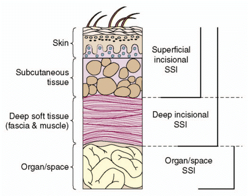 Figure 1 Surgical site infections (SSIs) are classified as superficial incisional SSI, deep incisional SSI and organ/space SSIs.Citation26