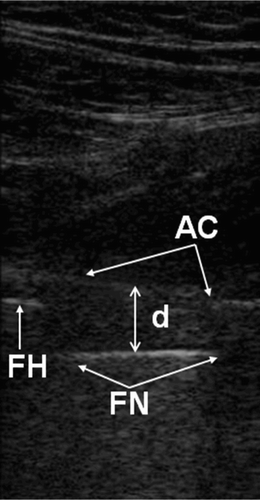 Figure 1. Sonographic measurement of the capsular distance in THA. AC: echo from the anterior surface of the anterior hip joint capsule; FN: echo from the anterior surface of the prosthetic femoral neck; FH: echo from the anterior surface of the prosthetic femoral head; d represents the distance between the anterior capsule and the prosthetic femoral neck.