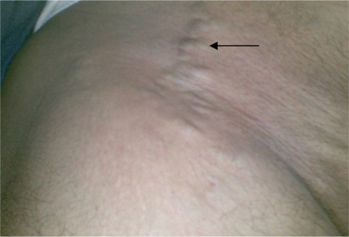 Figure 1 Superficial varicose veins of the right lower abdomen.