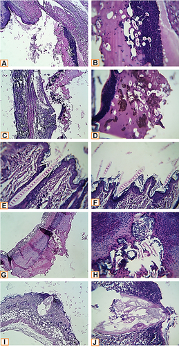 Figure 3 Histopathological examination of infected wound before and after treatment with L. plantarum and or L. inermis. (A and B) Infected group. Sections showed deep ulcerative lesions with complete exposure of the epidermis and extending to the dermis. An extensive inflammatory reaction with secondary infection and predominance of neutrophilic infiltration were seen. (C and D) Lactiplantibacillus cell group infected with S. aureus. A wide detached ulcer was seen overlying denuded dermal tissue. The ulcerated materials were mostly formed from suppurative exudate rich in neutrophils and contained contaminated saprophytes and amorphous brownish materials (bloody-like). (E and F) Lactiplantibacillus supernatant group infected with S. aureus. The skin structures were completely normal. An elongated septated eosinophilic contaminant of unknown nature was seen overlying the epidermis and superficially invaded it. (G and H) Lawsonia group infected with S. aureus. A huge detached ulcerative tissue was seen. It was formed from suppurative exudate rich in neutrophils, bacterial colonies, dead necrotic tissue, and saprophytic structures. (I and J) Combination group infected with S. aureus. A characteristic narrow, deep ulcerative lesion was seen. It extended deep to the hypodermis. The contents of the ulcer were funneled shape hyalinized membranous structures entangling necrotic debris. Neutrophils extensively infiltrated the adjacent skin tissue; other parts of the skin in the vicinity of the ulcer showed a florid inflammatory reaction, enclosing different types of leucocytes (H&E X400, zoomed section X30).