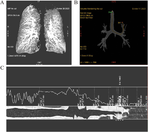 Figure 3 Chest CT image in control and COPD group.