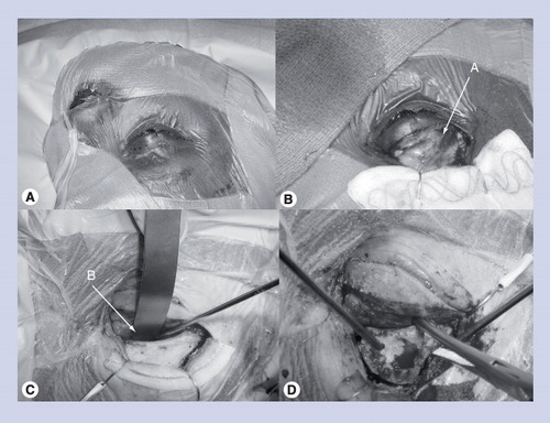 Figure 1. Eyelid incision for orbital osteotomy.Please note that the images are compiled from different patients. (A) Incision is marked in a crease in the upper eyelid and extends lateral to, but not involving, the lateral canthal ligament. (B) Image is shown with orbital septum preserved and eyelid flap retracted by fishhooks after utilizing a combination of sharp and blunt dissection. (C) Subperiosteal dissection is performed while preserving the orbital contents. (D) Image showing one-piece craniotomy-orbital ridge osteotomy being elevated after osteotomies are made with a craniotome.A: Orbital septum; B: Orbital ridge.