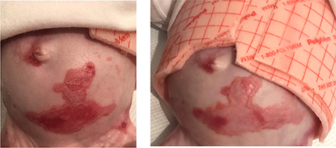 Figure 8 Chronic abdominal wound on infant with JEB-GS, demonstrating pre topical gentamicin use (left figure) with improvements after use (right figure).