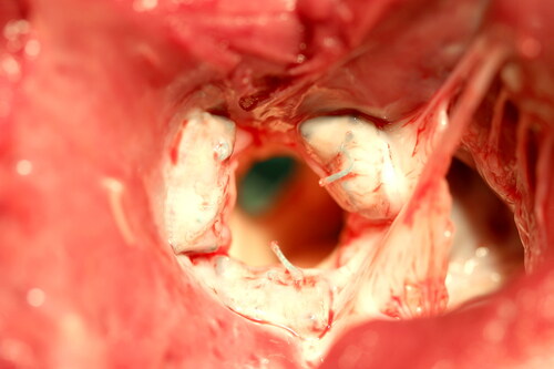 Figure 3. Photograph of annuloplasty ring segments healed into the aortic annulus in a Control group animal at 60-day gross exam. Note the fibrous appearance of the ring segments and the circumferential scarring of the left ventricle outflow tract and aortic annulus.