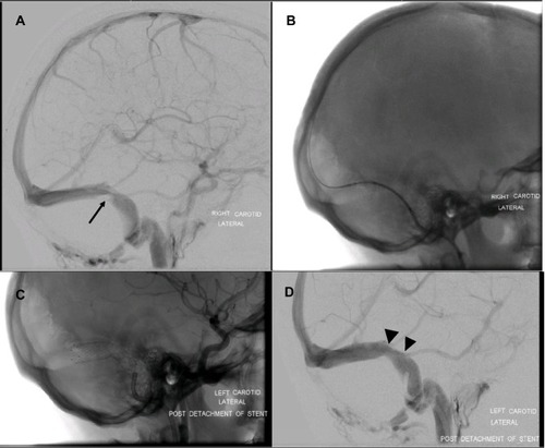 Figure 2 Intrinsic stenosis resolved by stent. This is an example of intrinsic stenosis of the right transverse-sigmoid sinus junction. Angiographic evidence of the stenosis (arrow) (A) followed by imaging during the opening of the stent in the venous sinus (B). Unsubtracted image of the stent released in the sinus (C) followed by evidence of relief of the stenosis and patency of the Labbé vein and the superficial middle cerebral vein (small arrowheads) (D).