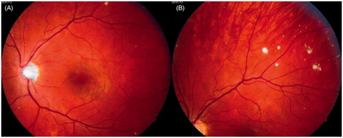 Figure 3. Photographs of the patient’s left eye fundus. A: posterior pole; B: periphery of the fundus. White spots present along retinal vessels with a distribution of changes similar to that seen in the right eye.