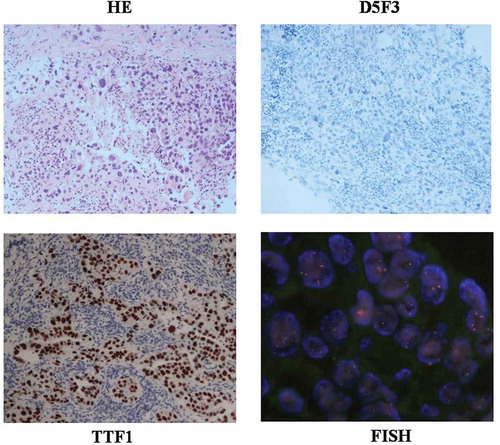 Figure 1. Hematoxylin and eosin(HE) staining, TTF1 staining, Ventana IHC(D5F3), and FISH staining slides from patient.