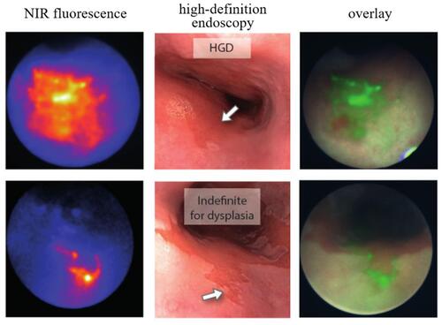 Figure 7 Real-time in situ NIR fluorescence imaging with bevacizumab-IRDye 800CW drug and high-definition endoscopy of oesophageal adenocarcinoma lesions. Dysplastic area missed during high-definition narrowband-imaging and white-light endoscopy inspection. Reproduced from Near-infrared fluorescence molecular endoscopy detects dysplastic oesophageal lesions using topical and systemic tracer of vascular endothelial growth factor A. Nagengast WB, Hartmans E, Garcia-Allende PB, et al. Gut. 68(1):7–10. Copyright 2019, with permission from BMJ Publishing Group Ltd.Citation119