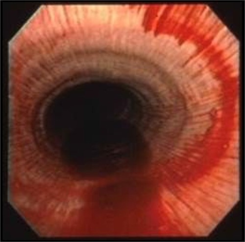 Figure 4 Blood in the trachea of a racehorse after maximal exercise as revealed by endoscopy.