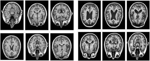 Figure 1. An example selection of MRI scans used to create the 3D digital model of hippocampus for the healthy brain (left) and atrophied brain by AD (right). The healthy brain MRI scans were obtained from the Open Access Series of Brain Imaging Studies’, OASIS database and the MRI scans for AD brain were obtained from the ‘Alzheimer’s Disease Neuroimaging Initiative’, ADNI database.