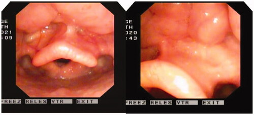 Figure 2. One month after the operation, the mucosa of the epiglottis lingual surface returned to normal.