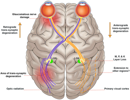 Figure 1 Schematic representation of trans-synaptic degeneration. Retinal ganglion cell atrophy leads to anterograde trans-synaptic degeneration along the optic nerve, optic tract, LGN, and optic radiation. Emerging theories suggest degeneration beyond these pathways, but this remains controversial.
