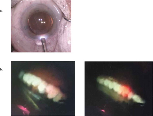 Figure 3. (a) The endoscopic cyclophotocoagulation probe (ECP) (Endo Optiks, Little Silver, NJ) entering an eye. (b) Two intraoperative views of ciliary process during ECP treatment. Photographs from the archives of Dr. David Solá-Del Valle