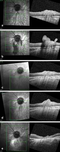 Figure 1. SD-OCT imaging of a retinal retinoblastoma relapse following epiretinal seed implantation. (a) Scan over the inferior parapapillary region at the end of the first-line treatment showing an intact retina. (b) Same region at time of the vitreous relapse showing a large epiretinal seed anchored and locally disrupting the inner limiting layer. (c) Complete regression of the epiretinal seed after four combined intravitreal melphalan and topotecan. (d) Isolated intra-retinal relapse 8 months later originating from the site of the inner limiting layer invasion at time of the vitreous seeding. (e) Flat retinal scar post thermotherapy.
