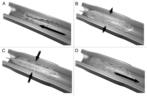 Figure 3. Drug eluting stents (A) Stent is mounted on a catheter and inserted at the diseased area. (B) Balloon is inflated which expanded the stent. (C) Balloon is then deflated leaving the drug eluting stent as a scaffold. (D) Catheter with deflated balloon is removed leaving the stent at the diseased site which then releases the medication. Reproduced with permission from reference Citation45.