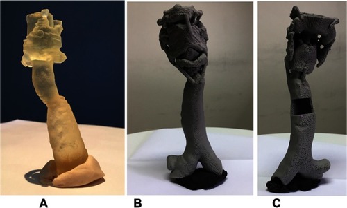 Figure 2 Two models of tracheal stenosis. (A) Lateral view, printed using resin. (B) and (C), anterior and posterior views, respectively, of tracheal stenosis created using FDM technology.