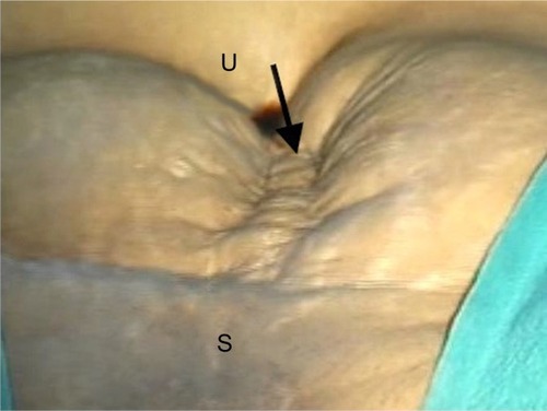 Figure 3 Dimpling (arrow) of the anterior abdominal wall scar during uterine sound retroversion test in a case with ventrofixed uterus in upper-third of the line drawn between umbilicus and symphysis pubis.