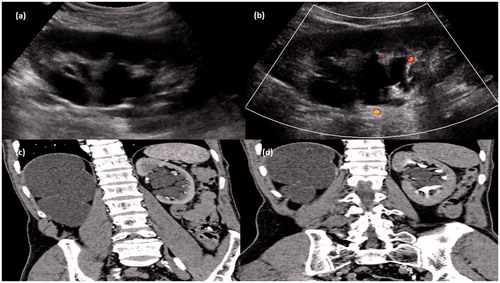 Figure 5. Gray-scale ultrasound image (a) of left kidney showing an echoiec collection in peripelvic region which showed no evidence of color flow (b) on color Doppler study. CT scan arterial phase (c) and delayed phase (d) in coronal plane showing collection in peripelvic region with no evidence of contrast within it. The grossly hydronephrotic contralateral kidney is also seen.