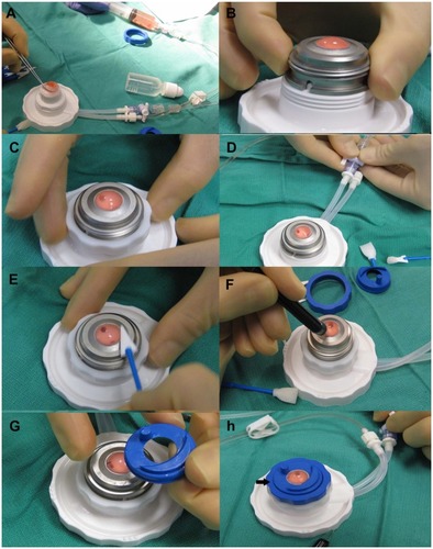Figure 3 (A) The cornea scleral button is centered on the anterior chamber while infusing Optisol through a syringe. (B) Once centration is achieved, the metal cover is placed over the cornea so that the groove fits into the white notch on the base of the anterior chamber. (C) A white locking ring is then tightened. (D) The balanced salt solution port is opened and then closed to equilibrate the pressure. (E) Epithelium is removed with a Weck-cell. (F) Pachymetry is measured in four quadrants to determine the thickest area of the cornea. (G) The guide ring is oriented so that the reference dot (arrow) is aligned with the alignment mark which is placed in the thickest quadrant of the cornea. (H) The stopcock to the balanced salt solution infusion is opened for a few seconds to equilibrate the pressure again prior to the first pass.