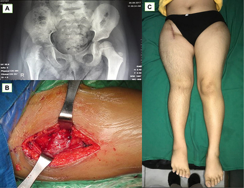 Figure 1 (A) Pelvic x ray of a 9 years old girl with complaint of right pain and limping gait; (B) Intra operatively we found casseous necrosis and pus inside the right Hip joint; (C) Three years after the operation there was residual limb discrepancy.