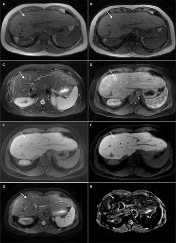 Figure 11 A 46-year-old female with metastatic rectal cancer to the liver.