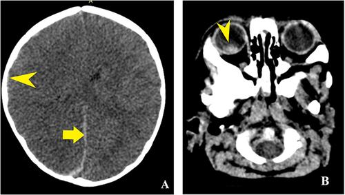 Figure 6 Axial NECT of a 7-month-old boy. Right SDH and retinal haemorrhage. (A) Thin hyperdense collection in the right parietal region (yellow pointed arrow) and also parafalcine SDH on the same side (yellow pointed arrow). (B) Hyperdense area in the posterior aspect of the vitreous humor (red pointed arrow). (Abusive head trauma was confirmed based on the clinical exam, neuroimaging, lab results and also on the confession of the caregiver.).