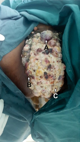 Figure 1 A photo taken during examination under anesthesia showing a massive vulval mass.