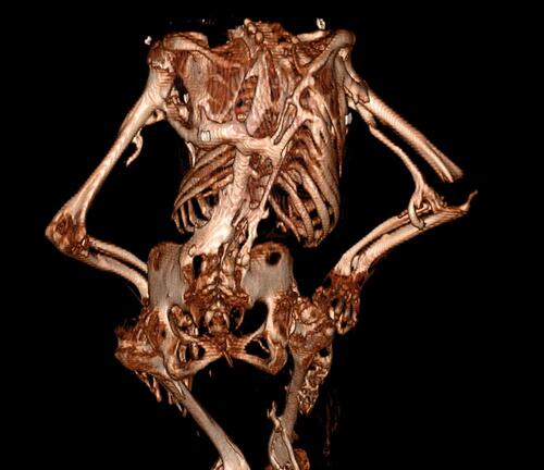 Figure 2 3D reconstruction of low-dose whole-body computed tomography scan of an adult patient with advanced FOP. There are prominent ossifications across the back, neck and chest, surrounding both hips and along the humeri leading to an altered stature and almost complete ankylosis of the joints.