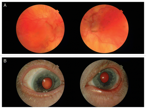 Figure 7. Eye changes. (A) Retinal degenerative changes. (B) Limbal corneal neovascularization.